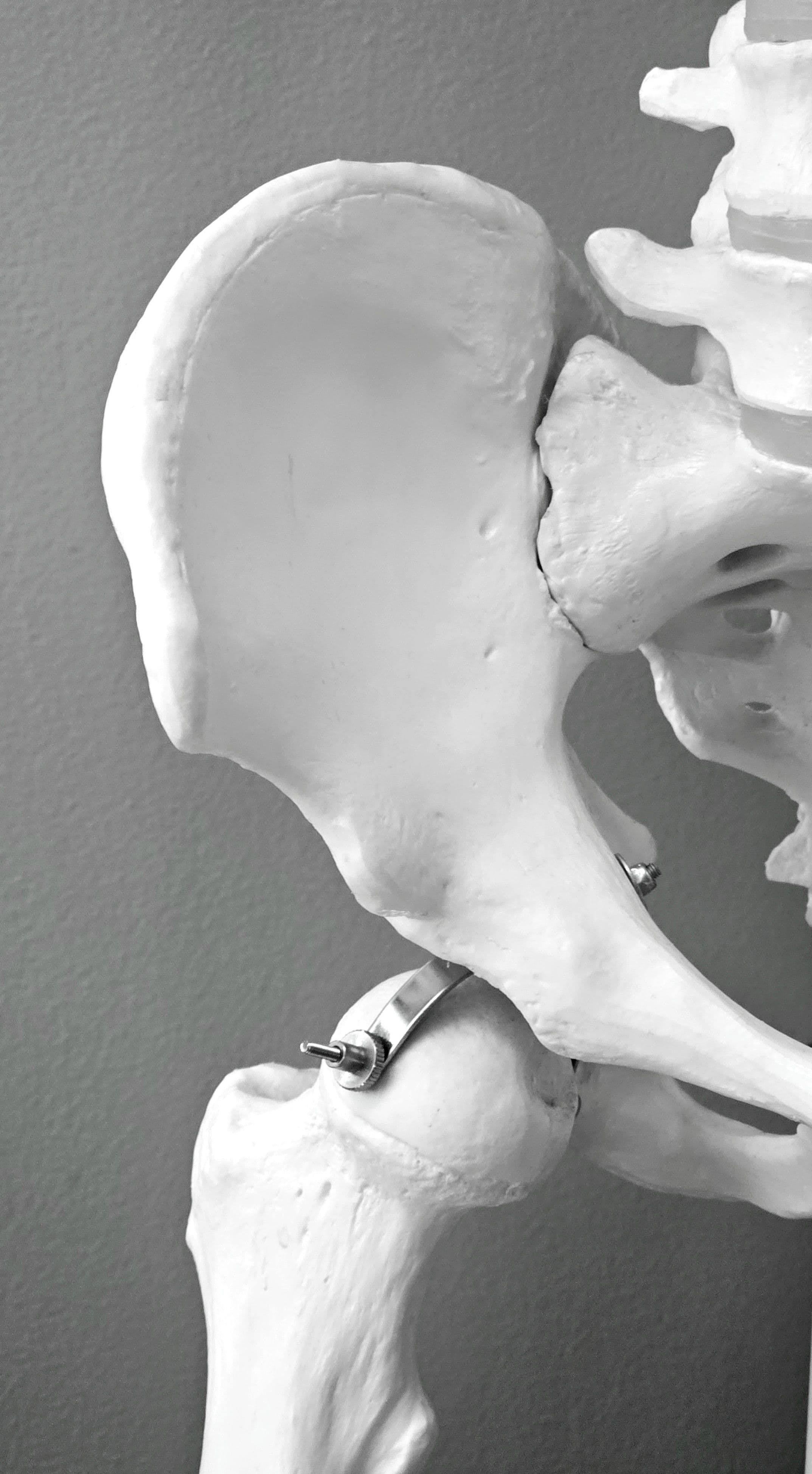 Hip Replacement